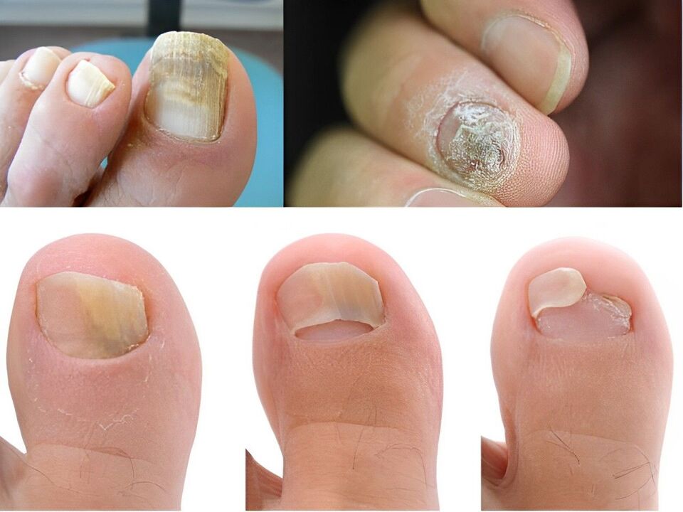 céim onychomycosis